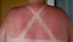 photo credit: erikogan <a href="http://www.flickr.com/photos/15013772@N00/4264210318">Owie</a> via <a href="http://photopin.com">photopin</a> <a href="https://creativecommons.org/licenses/by-sa/2.0/">(license)</a>